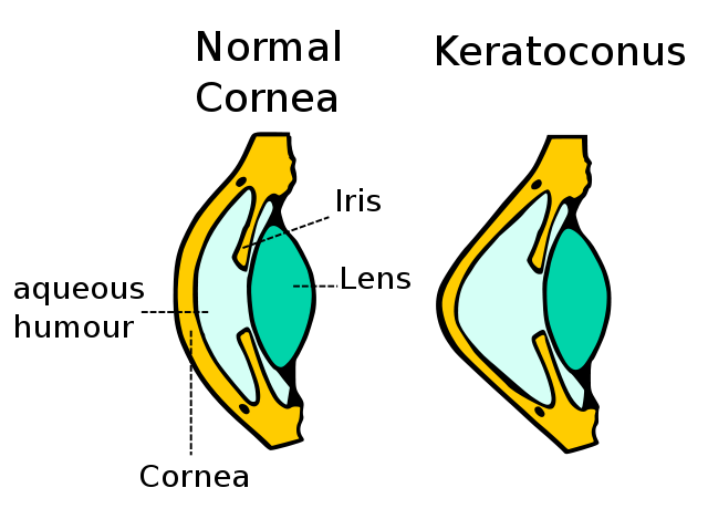 A schematic diagram showing change in cornea. 